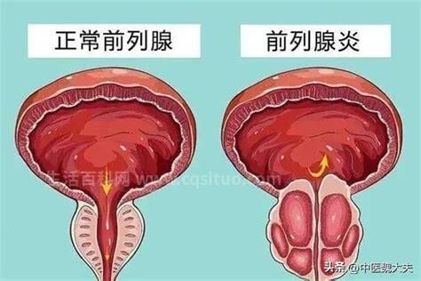 慢性前列腺炎是什么