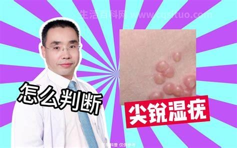 尖锐湿疣是性病吗