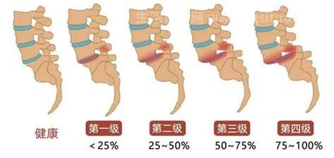 椎体滑脱是什么