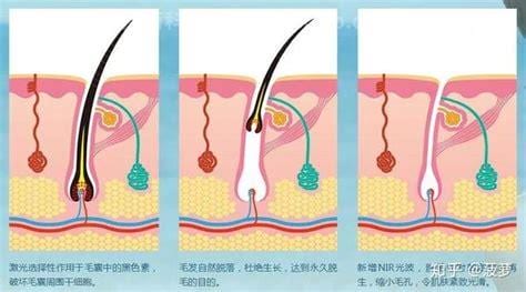 怎样永久脱毛