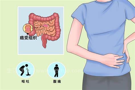 小肠癌的早期症状及表现