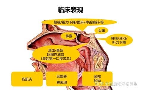 鼻咽癌早期三大症状