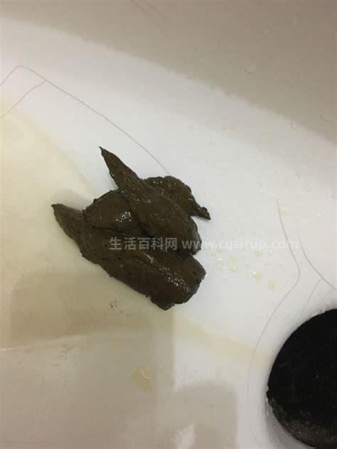 大便墨绿色偏黑又很粘是怎么回事