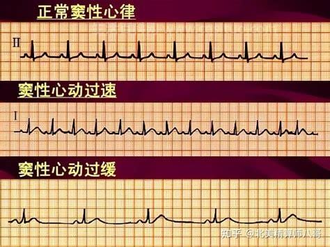 异常心电图是什么意思