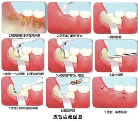 拔智齿的过程图解