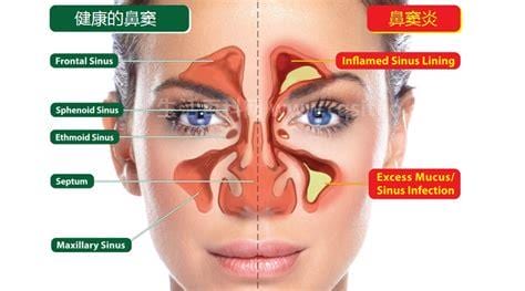 鼻子里白色特别黏的鼻涕