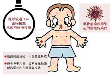 水痘通过什么方式传染