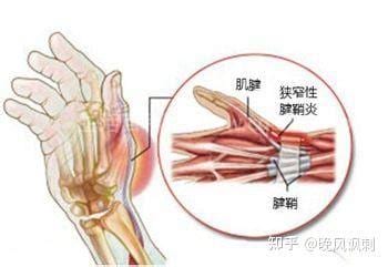 腱鞘炎多久可以自愈