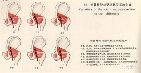 梨状肌不治会自己好吗