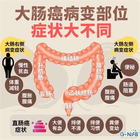 肠道癌症的早期症状