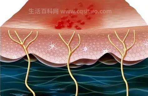 蛇盘疮最佳治疗方法