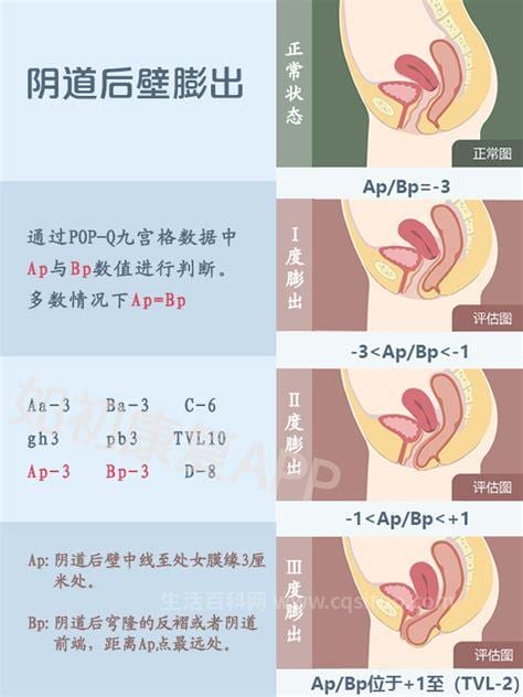 什么是阴道壁脱垂