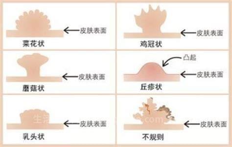 尖锐湿疣早期的症状