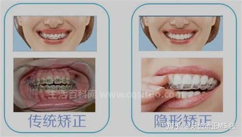 隐形牙套和钢丝牙套哪个效果更好