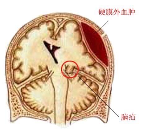 脑疝是什么意思