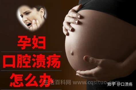 孕妇口腔溃疡