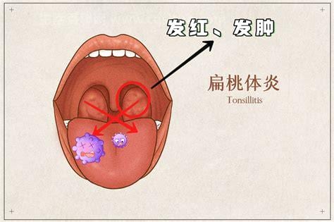 扁桃体发炎咳嗽很严重